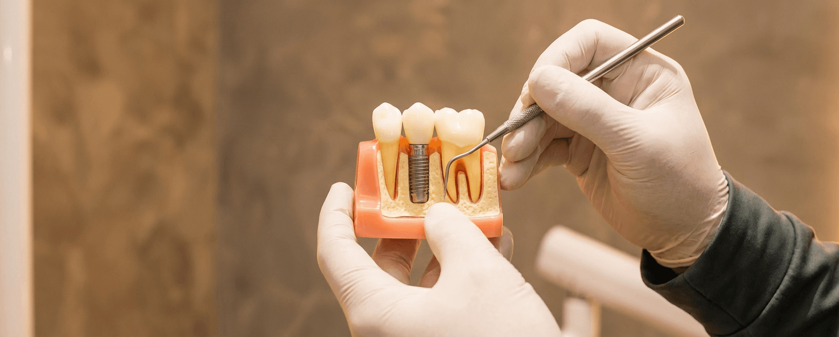 Reabilitação Oral com Implantes